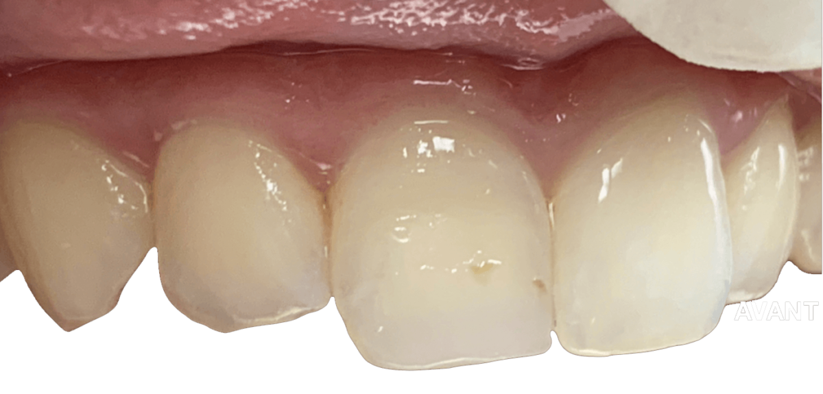Seringues De Résine Composite Dentaire Hybride - 1 à 10 Pièces, Blanc éclatant Pour Esthétique