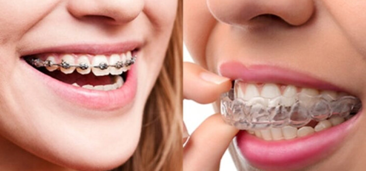 Orthodontie adulte